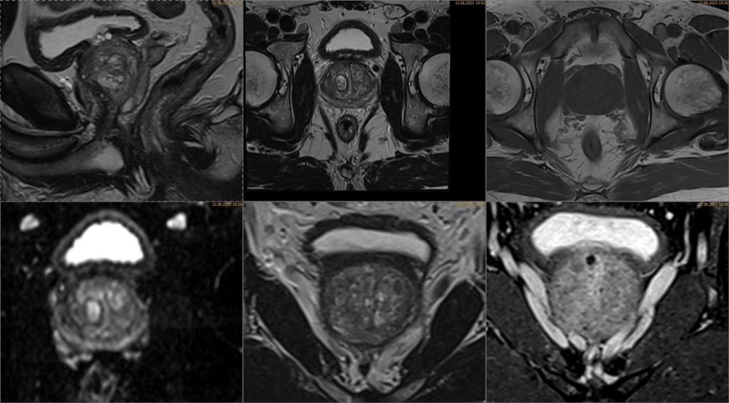 MRT-Aufnahme der Prostata mit sichtbaren anatomischen Strukturen